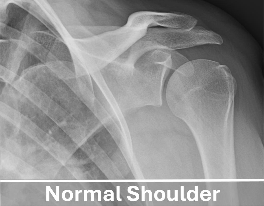 Normal left shoulder