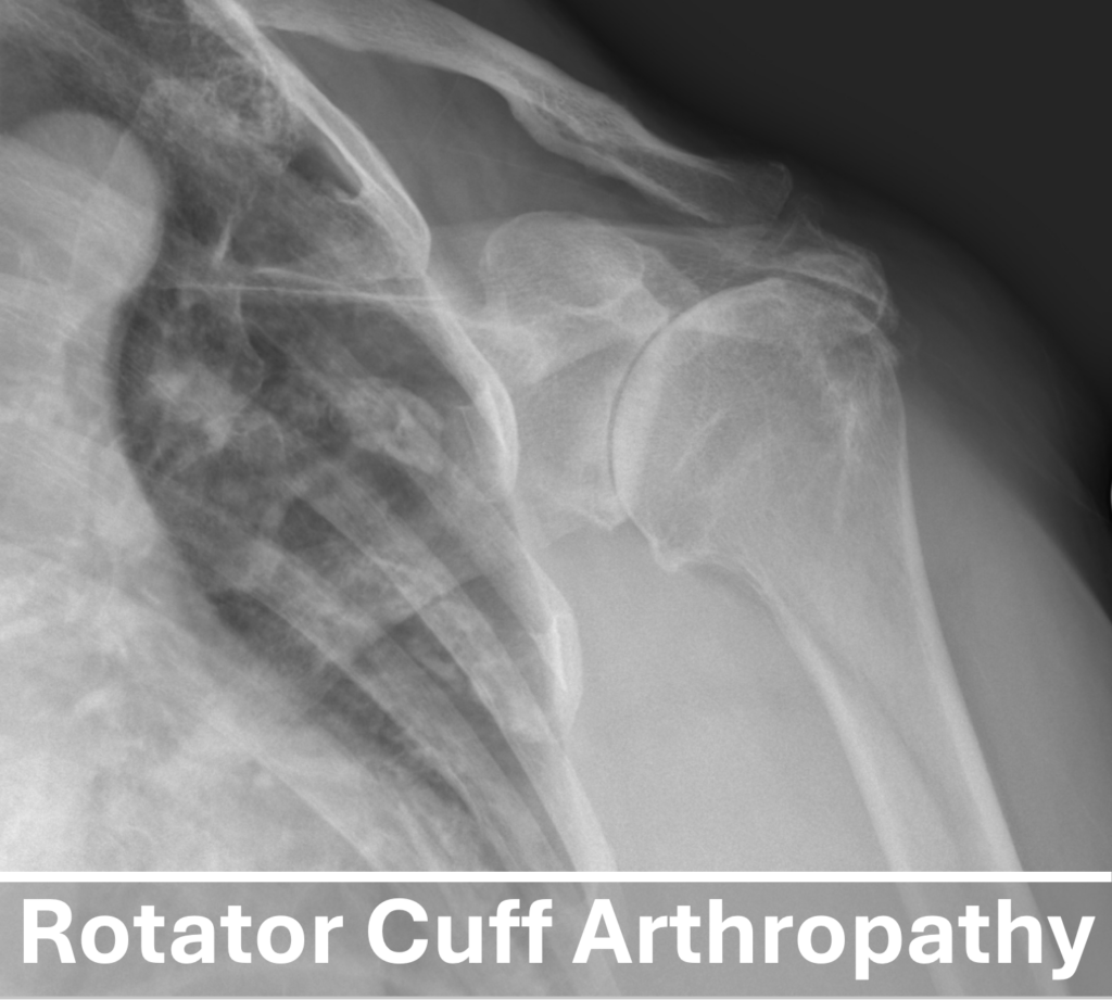 Rotator cuff arthropathy