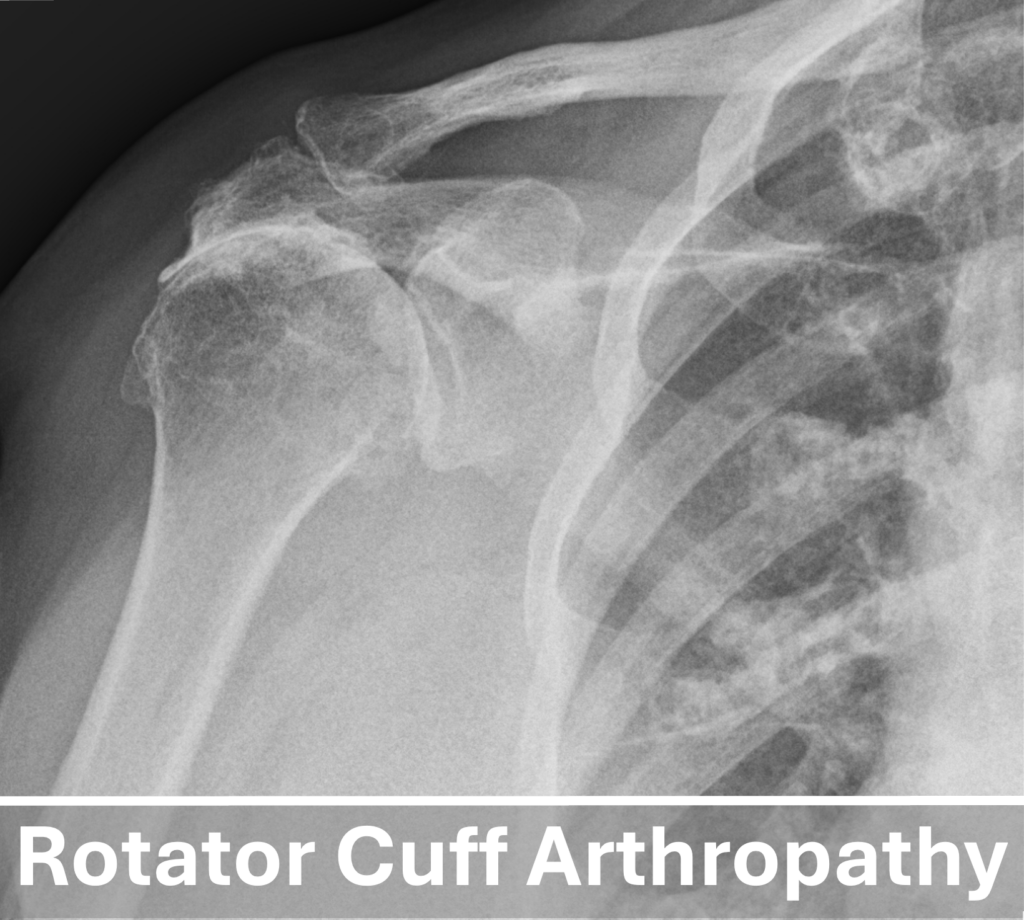 Right Rotator cuff arthropathy