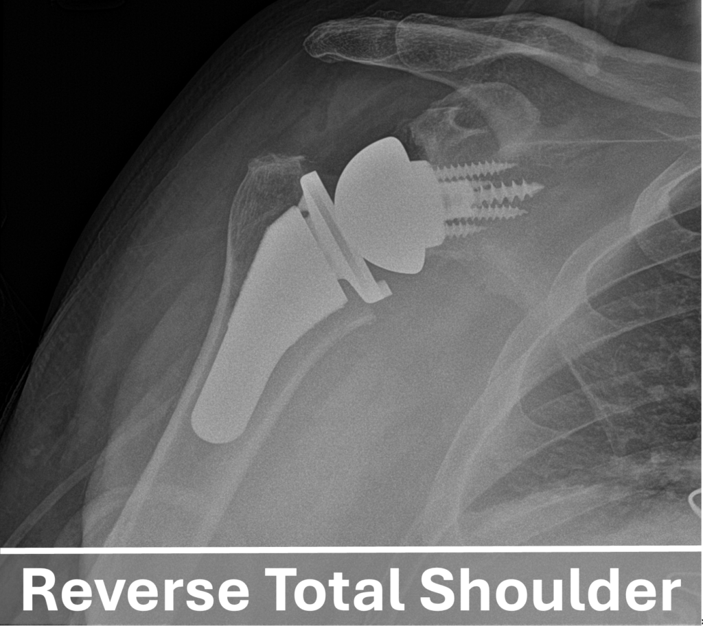Reverse total shoulder