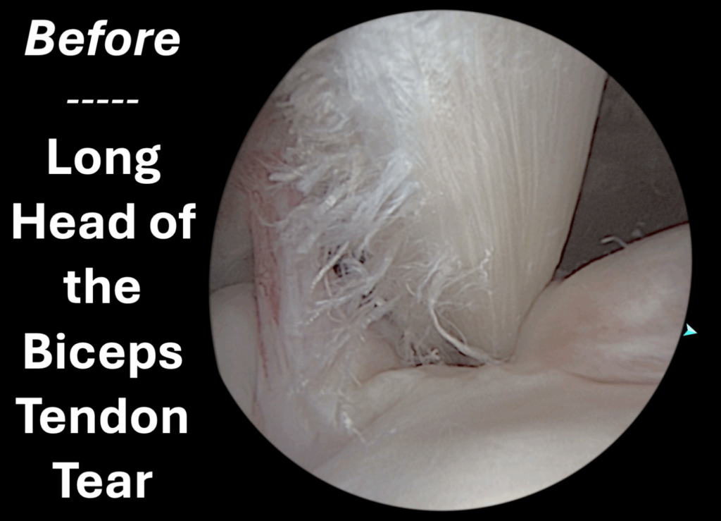 Long Head of the biceps tendon Tear