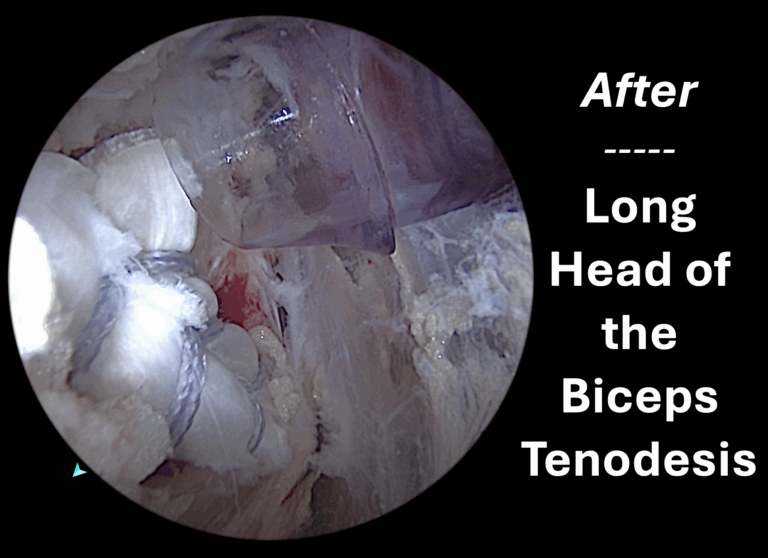 Long head of the biceps tenodesis