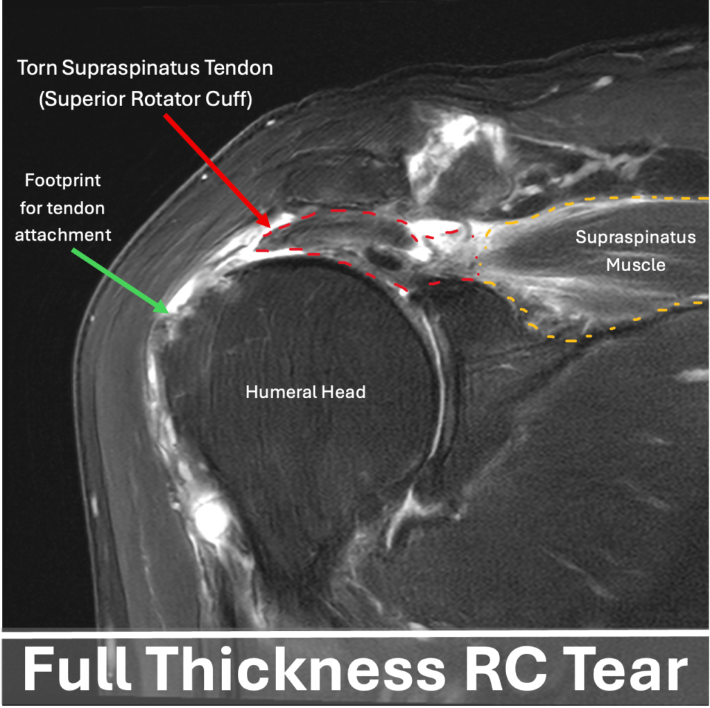 Full Thickness RC Tear