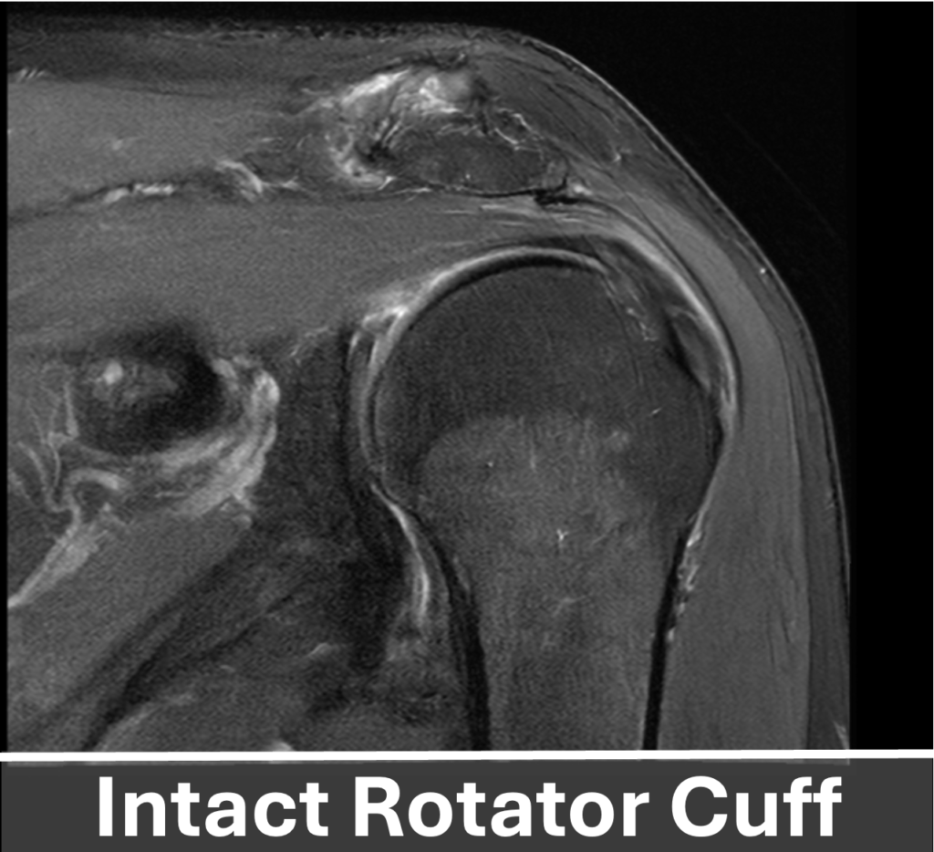 Intact Rotator Cuff