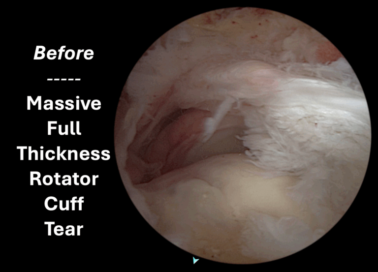 Massive Full Thickness Rotator Cuff Tear