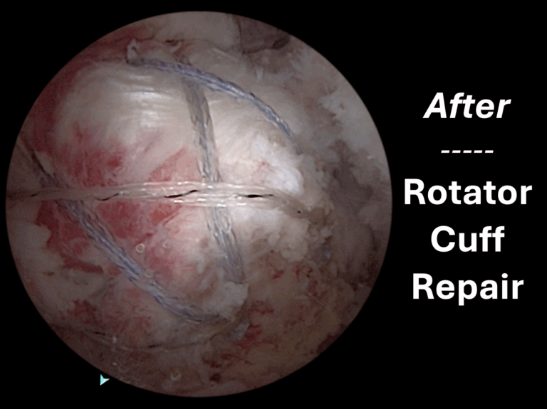 Rotator Cuff Repair