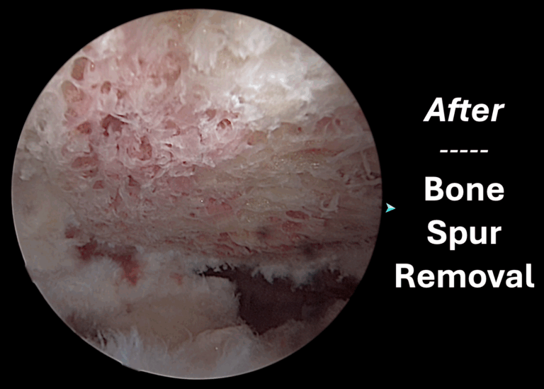 Bone Spur Removal