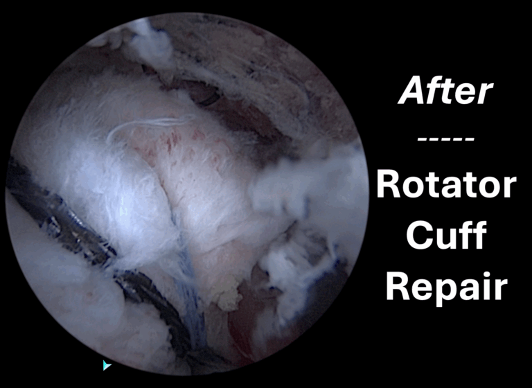 Rotator cuff repair