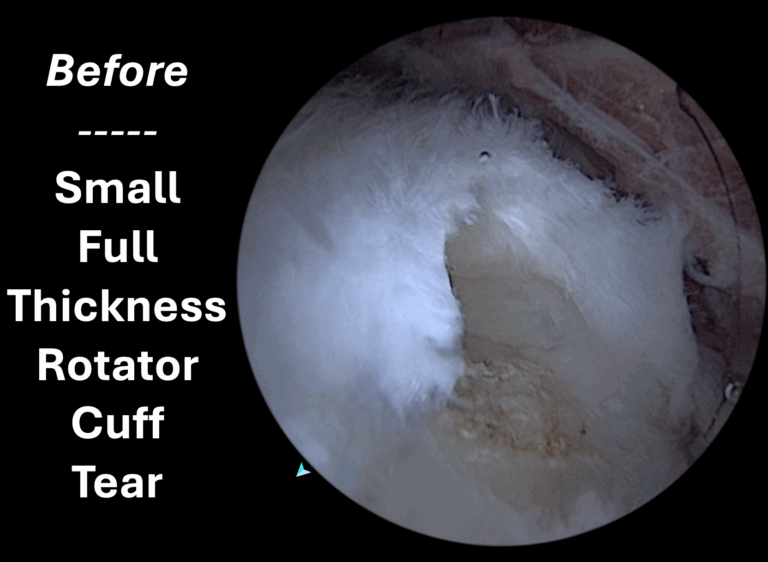 Small full thickness rotator cuff tear
