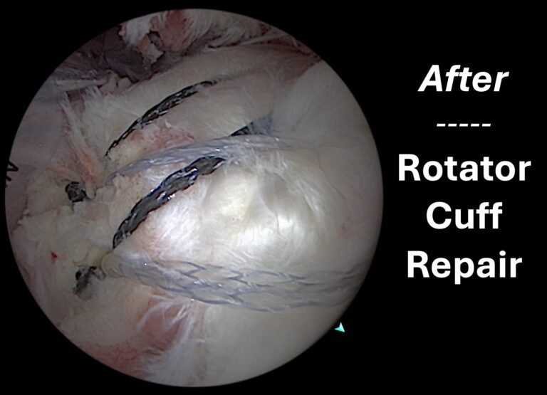 Rotator cuff repair